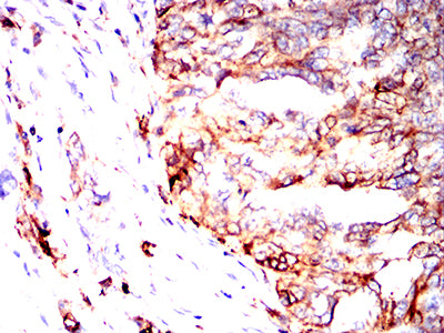 Figure 6:Immunohistochemical analysis of paraffin-embedded ovarian cancer tissues using HLA-DPA1 mouse mAb with DAB staining.