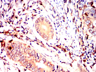 Figure 6:Immunohistochemical analysis of paraffin-embedded rectal cancer tissues using HLA-DPA1 mouse mAb with DAB staining.