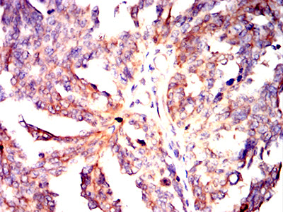 Figure 5:Immunohistochemical analysis of paraffin-embedded ovarian cancer tissues using HLA-DPA1 mouse mAb with DAB staining.