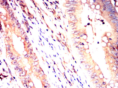 Figure 5:Immunohistochemical analysis of paraffin-embedded human rectum cancer tissues using PDGFA mouse mAb with DAB staining.