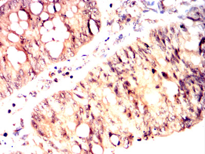 Figure 6:Immunohistochemical analysis of paraffin-embedded human rectum cancer tissues using ID3 mouse mAb with DAB staining.