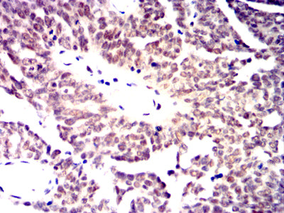 Figure 5:Immunohistochemical analysis of paraffin-embedded ovarian cancer tissues using MRE11 mouse mAb with DAB staining.