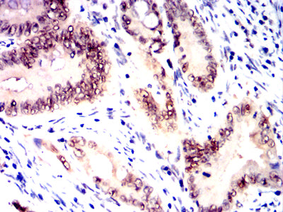 Figure 6:Immunohistochemical analysis of paraffin-embedded rectal cancer tissues using MRE11 mouse mAb with DAB staining.