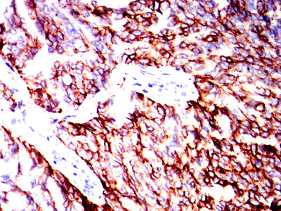 Figure 3:Immunohistochemical analysis of paraffin-embedded Ovarian cancer tissues using HLA-DPB1 mouse mAb with DAB staining.