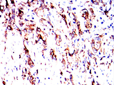 Figure 4:Immunohistochemical analysis of paraffin-embedded gastric cancer tissues using HLA-DPB1 mouse mAb with DAB staining.