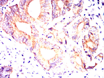 Figure 4:Immunohistochemical analysis of paraffin-embedded Colon cancer tissues using MUC13 mouse mAb with DAB staining.