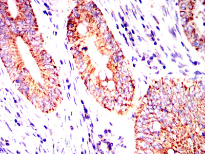 Figure 5:Immunohistochemical analysis of paraffin-embedded rectal cancer tissues using MUC13 mouse mAb with DAB staining.