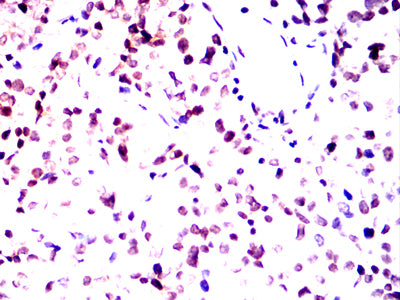 Figure 4:Immunohistochemical analysis of paraffin-embedded bladder tissues using ATM mouse mAb with DAB staining.