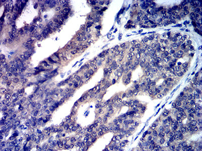 Figure 6:Immunohistochemical analysis of paraffin-embedded ovarian cancer tissues using CD258 mouse mAb with DAB staining.