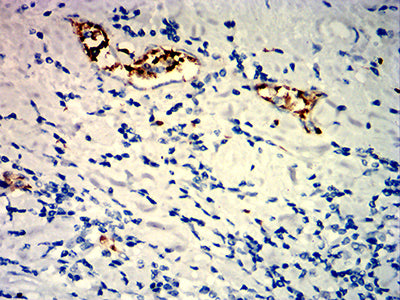 Figure 4:Immunohistochemical analysis of paraffin-embedded stomach cancer tissues using MUC12 mouse mAb with DAB staining.