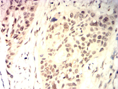Figure 7:Immunohistochemical analysis of paraffin-embedded esophageal cancer tissues using Jurkat mouse mAb with DAB staining.