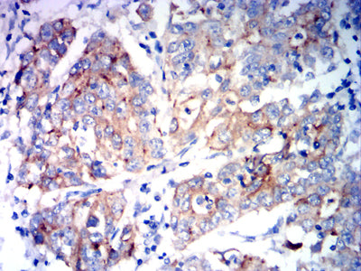 Figure 7:Immunohistochemical analysis of paraffin-embedded stomach cancer tissues using KCNK1 mouse mAb with DAB staining.