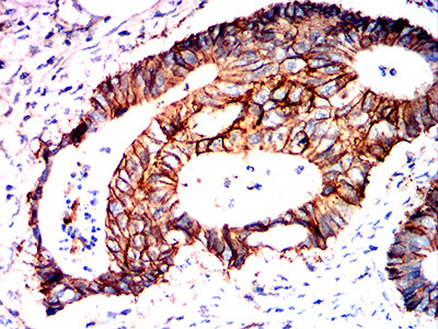 Figure 8:Immunohistochemical analysis of paraffin-embedded rectum cancer tissues using ATP1A1 mouse mAb with DAB staining.