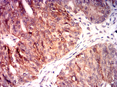 Figure 7:Immunohistochemical analysis of paraffin-embedded ovarian cancer tissues using IL22 mouse mAb with DAB staining.