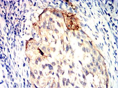 Figure 9:Immunohistochemical analysis of paraffin-embedded cervical cancer tissues using CDK4 mouse mAb with DAB staining.