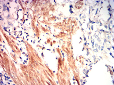 Figure 10:Immunohistochemical analysis of paraffin-embedded gastric cancer tissues using RHOA mouse mAb with DAB staining.