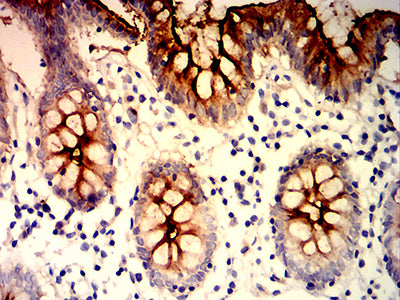 Figure 6:Immunohistochemical analysis of paraffin-embedded colon tissues using CEACAM6 mouse mAb with DAB staining.