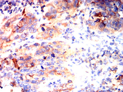 Figure 6:Immunohistochemical analysis of paraffin-embedded endometrial cancer tissues using TSPAN33 mouse mAb with DAB staining.