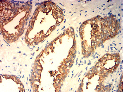 Figure 6:Immunohistochemical analysis of paraffin-embedded prostate cancer tissues using KLK2 mouse mAb with DAB staining.