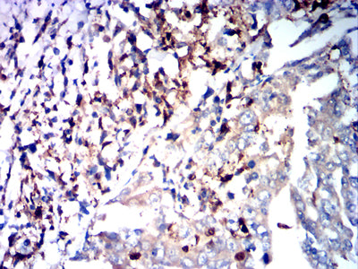 Figure 6:Immunohistochemical analysis of paraffin-embedded stomach cancer tissues using PTH mouse mAb with DAB staining.