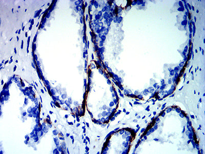 Figure 7:Immunohistochemical analysis of paraffin-embedded prostate cancer tissues using KRT13 mouse mAb with DAB staining.