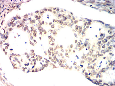 Figure 9:Immunohistochemical analysis of paraffin-embedded rectal cancer tissues using XRCC1 mouse mAb with DAB staining.