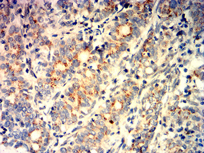 Figure 6:Immunohistochemical analysis of paraffin-embedded cervical cancer tissues using GOLGA2 mouse mAb with DAB staining.
