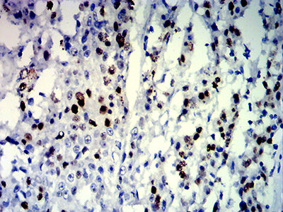 Figure 6:Immunohistochemical analysis of paraffin-embedded esophageal cancer tissues using MKI67 mouse mAb with DAB staining.