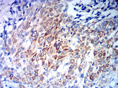 Figure 7:Immunohistochemical analysis of paraffin-embedded esophageal cancer tissues using CCR10 mouse mAb with DAB staining.