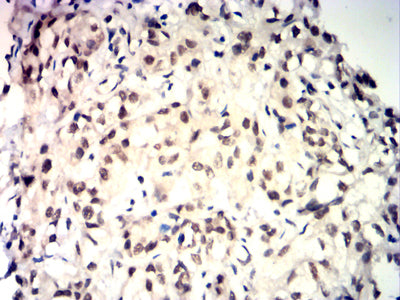 Figure 6:Immunohistochemical analysis of paraffin-embedded baldder cancer tissues using TDP43 mouse mAb with DAB staining.