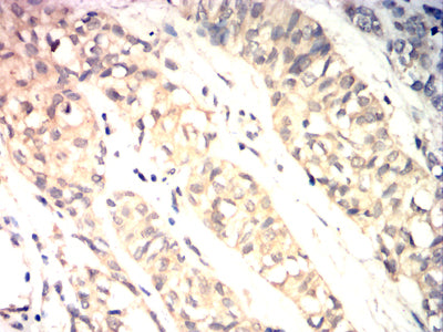 Figure 5:Immunohistochemical analysis of paraffin-embedded bladder cancer tissues using TRIB2 mouse mAb with DAB staining.