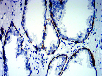 Figure 6:Immunohistochemical analysis of paraffin-embedded prostate cancer tissues using KRT13 mouse mAb with DAB staining.