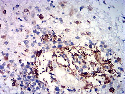 Figure 6:Immunohistochemical analysis of paraffin-embedded brain tumor tissues using HMOX1 mouse mAb with DAB staining.