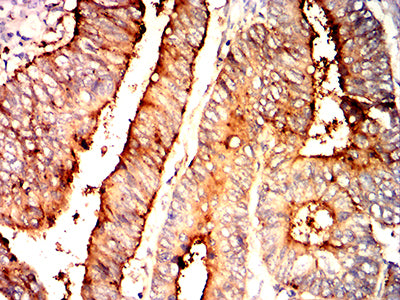 Figure 6:Immunohistochemical analysis of paraffin-embedded rectum cancer tissues using CEACAM6 mouse mAb with DAB staining.