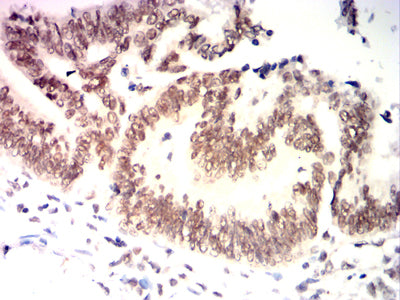 Figure 8:Immunohistochemical analysis of paraffin-embedded rectal cancer tissues using Jurkat mouse mAb with DAB staining.