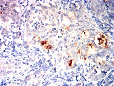 Figure 7:Immunohistochemical analysis of paraffin-embedded cervical cancer tissues using B4GALNT1 mouse mAb with DAB staining.