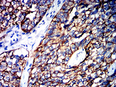 Figure 7:Immunohistochemical analysis of paraffin-embedded bladder cancer tissues using KRT15 mouse mAb with DAB staining.