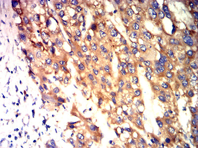 Figure 5:Immunohistochemical analysis of paraffin-embedded liver cancer tissues using CD321 mouse mAb with DAB staining.