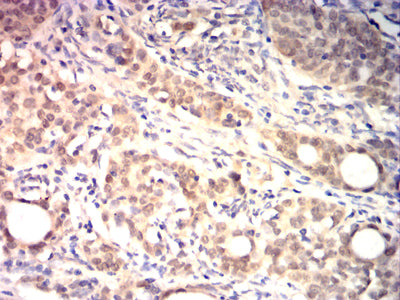 Figure 8:Immunohistochemical analysis of paraffin-embedded cervical cancer tissues using HSP70 mouse mAb with DAB staining.