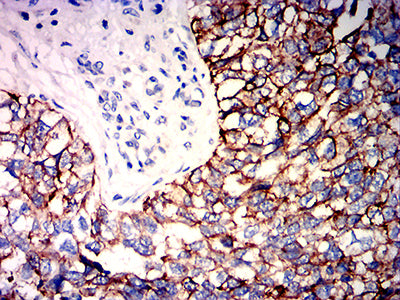 Figure 8:Immunohistochemical analysis of paraffin-embedded bladder cancer tissues using KRT2 mouse mAb with DAB staining.