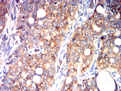 Figure 7:Immunohistochemical analysis of paraffin-embedded cervical cancer tissues using P4HB mouse mAb with DAB staining.