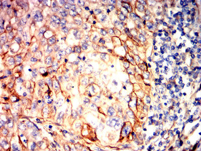 Figure 8:Immunohistochemical analysis of paraffin-embedded lung cancer tissues using SCARB1 mouse mAb with DAB staining.