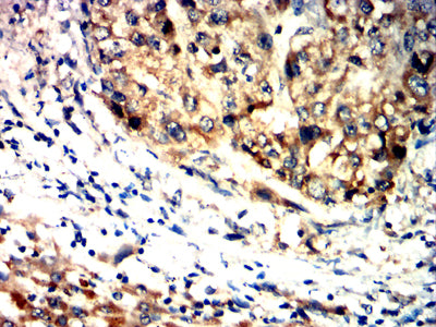 Figure 8:Immunohistochemical analysis of paraffin-embedded liver cancer tissues using MR1 mouse mAb with DAB staining.