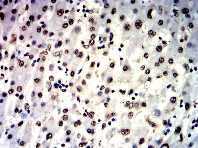 Figure 8:Immunohistochemical analysis of paraffin-embedded liver cancer tissues using IL1B mouse mAb with DAB staining.