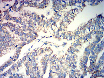 Figure 6:Immunohistochemical analysis of paraffin-embedded stomach cancer tissues using ATP5F1A mouse mAb with DAB staining.