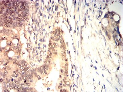 Figure 10:Immunohistochemical analysis of paraffin-embedded rectal cancer tissues using HSP70 mouse mAb with DAB staining.