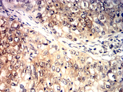 Figure 7:Immunohistochemical analysis of paraffin-embedded breast cancer tissues using HSP70 mouse mAb with DAB staining.