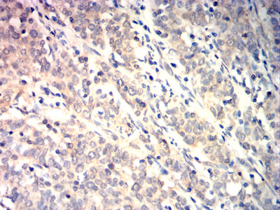 Figure 6:Immunohistochemical analysis of paraffin-embedded cervical cancer tissues using TRIB2 mouse mAb with DAB staining.
