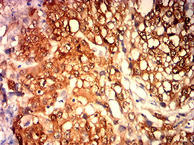 Figure 6:Immunohistochemical analysis of paraffin-embedded liver cancer tissues using MAGEA4 mouse mAb with DAB staining.