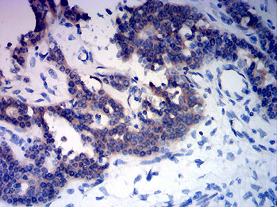 Figure 5:Immunohistochemical analysis of paraffin-embedded ovarian cancer tissues using RABEP2 mouse mAb with DAB staining.
